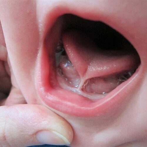 Μητρικός θηλασμός και κοντός χαλινός της γλώσσας