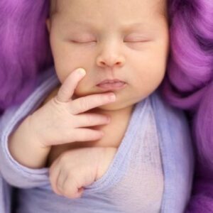 Νεογνικός ίκτερος