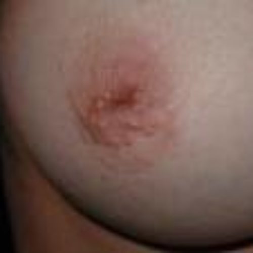 Επίπεδες, εισέχουσες ή ανεστραμμένες θηλές. Τι είναι;