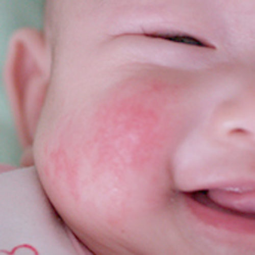 Μητρικό γάλα: Νέα ένδειξη θεραπείας για την ατοπική δερματίτιδα στα βρέφη